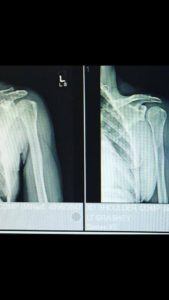 Shoulder X-ray of Anna Woods shoulder injury